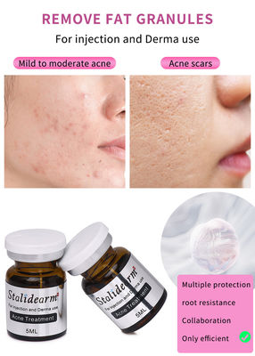 Fabbrica di forniture Skin Booster Pimples Repair Acne Treatment Rimozione dei caspetti neri Mesoterapia Iniezione di siero OEM/ODM