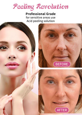 30 ml di siero per peeling della pelle / set liquido di qualità professionale per soluzione di esfoliazione della pelle del viso