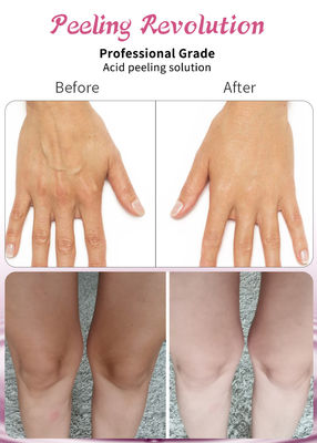 Siero di peeling di alta qualità favorisce la rigenerazione del collagene e eleva la pelle
