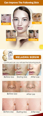 Il siero meso Melasma della lentiggine di rimozione di Microneedling del siero di Skincare pela l'imbiancatura