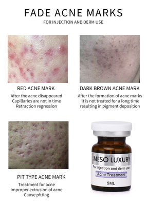 I punti rossi di Mesotherapy della gioventù dell'iniezione di lusso del siero pelano il trattamento dell'iniezione dell'acne